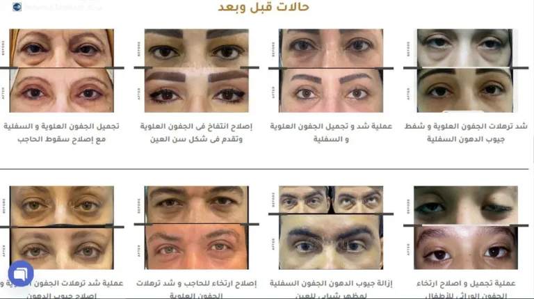 عمليات شد الجفون قبل وبعد